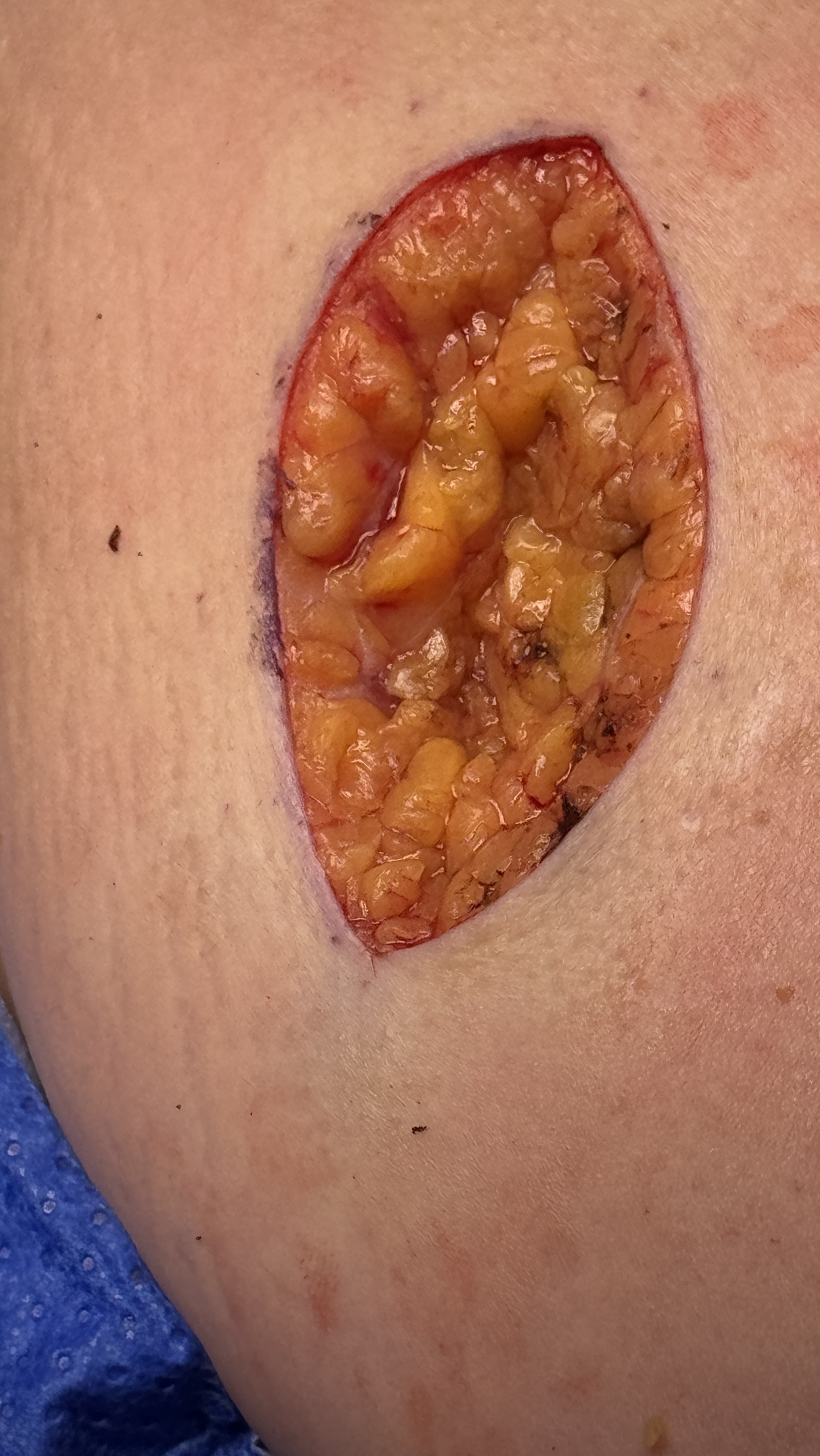 Skin cancer excision example image