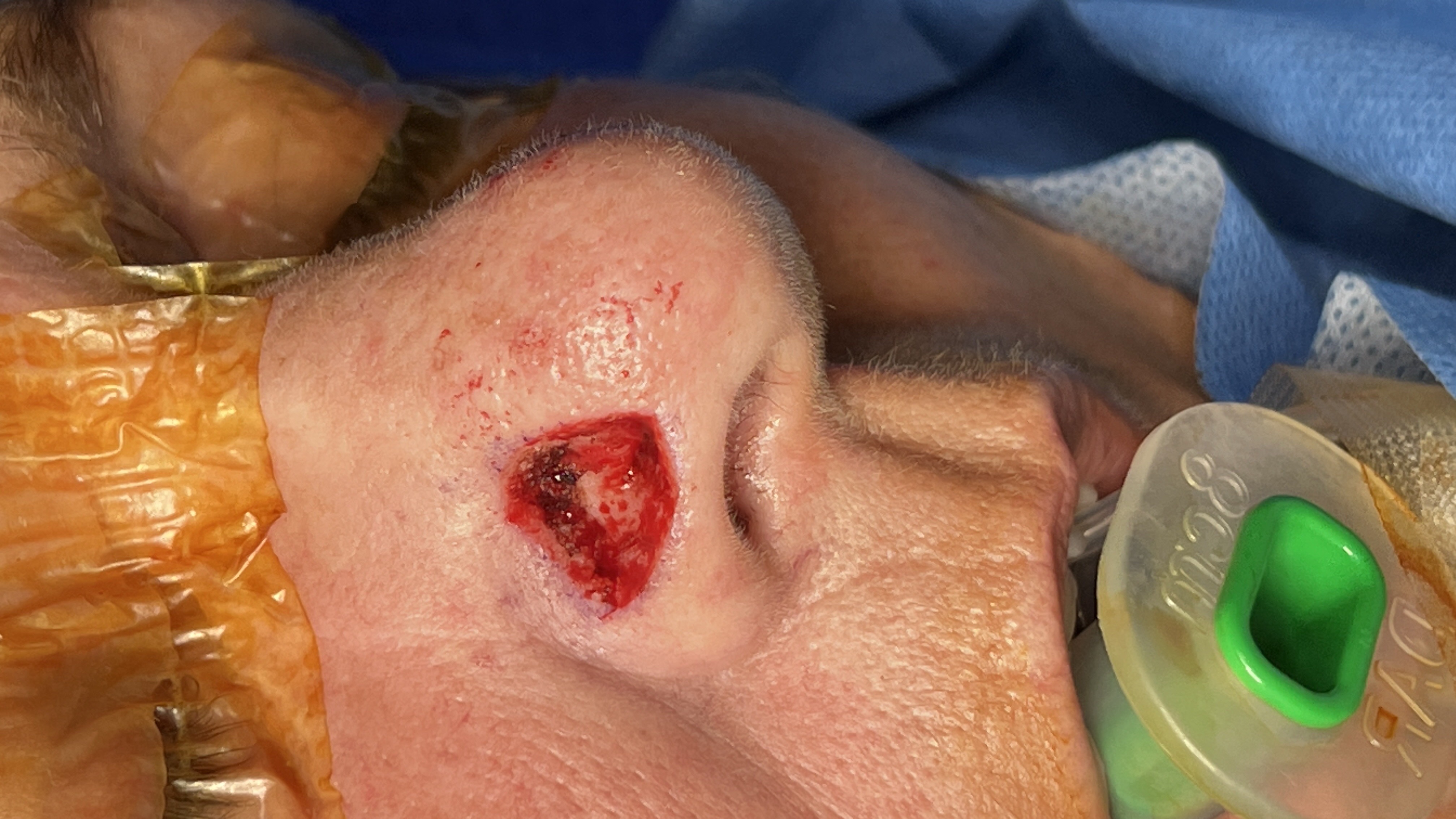 Post-excision skin cancer surgical-defect example image